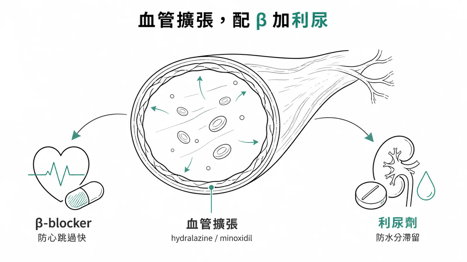 直接血管擴張劑要配 β-blocker 防反射性心搏過速、配利尿劑防體液滯留