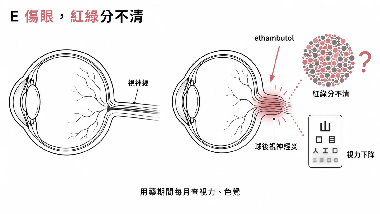 ethambutol 的招牌毒性是視神經炎,經典表現是紅綠色盲,用藥期間每月查視力與色覺