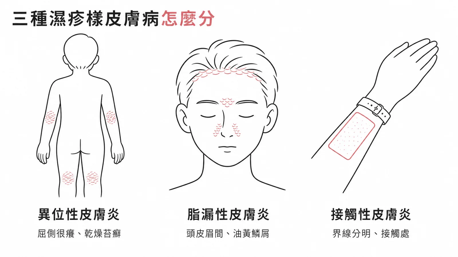 濕疹樣皮膚病鑑別:異位性、脂漏性、接觸性皮膚炎的分布與特徵對照