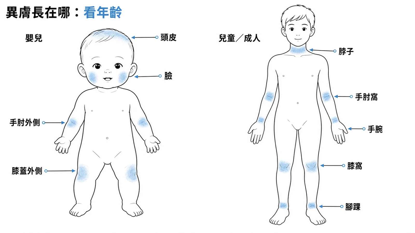 異位性皮膚炎年齡分布:嬰兒在臉與四肢伸側,兒童成人在屈側