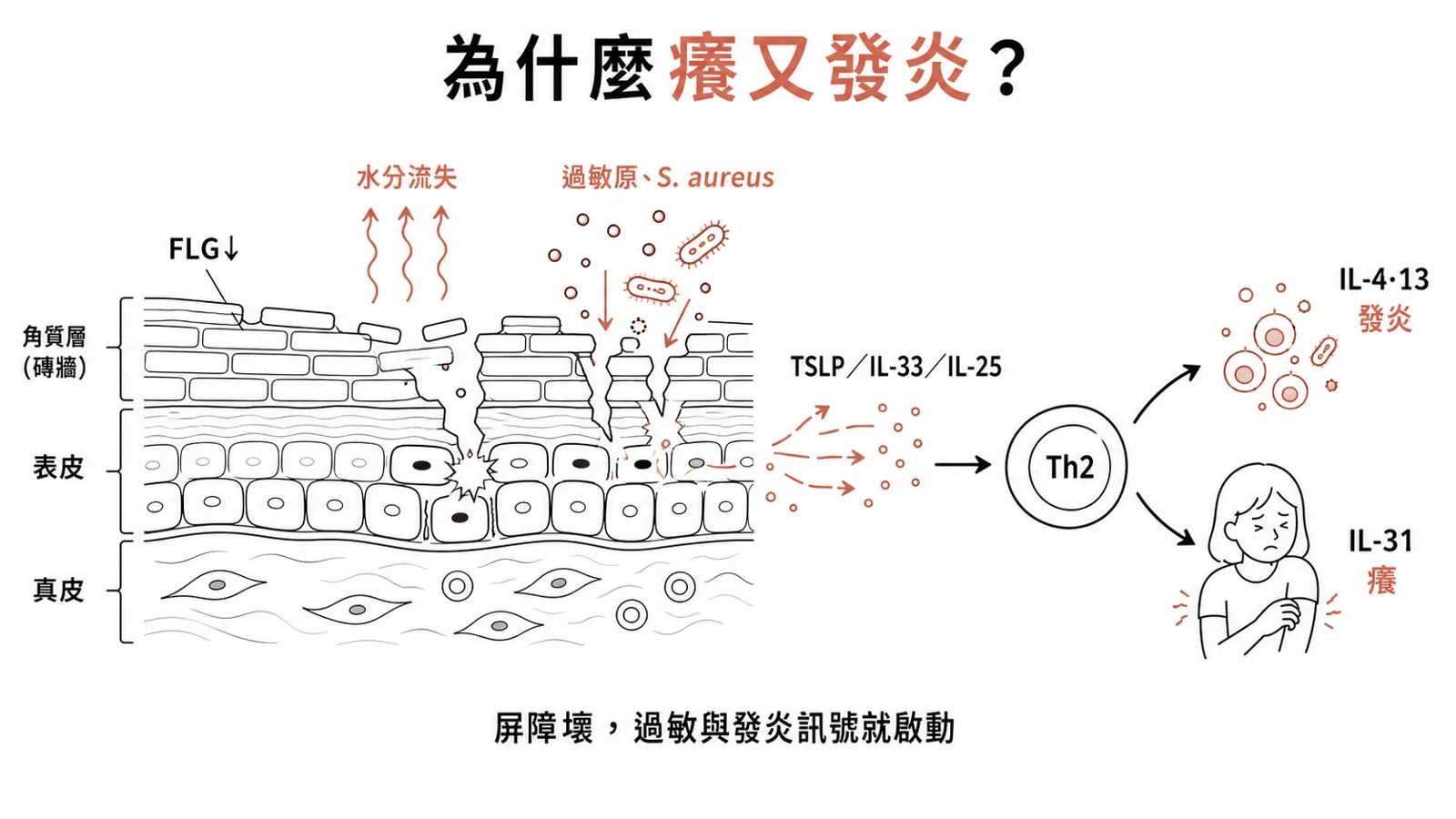 異位性皮膚炎機轉:filaggrin 屏障缺損啟動 Th2 級聯,IL-4/13 發炎、IL-31 搔癢