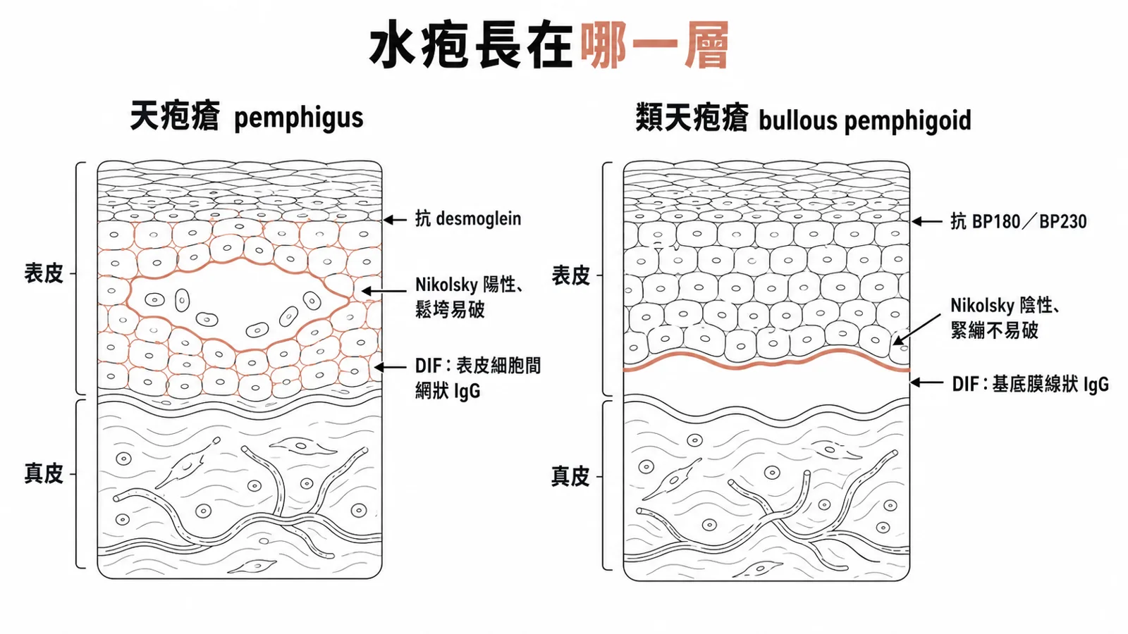 天疱瘡與類天疱瘡的皮膚剖面對照:天疱瘡水疱在表皮內、抗 desmoglein、Nikolsky 陽性、鬆垮易破、DIF 表皮細胞間網狀 IgG;類天疱瘡水疱在表皮下、抗 BP180/BP230、Nikolsky 陰性、緊繃不易破、DIF 基底膜線狀 IgG