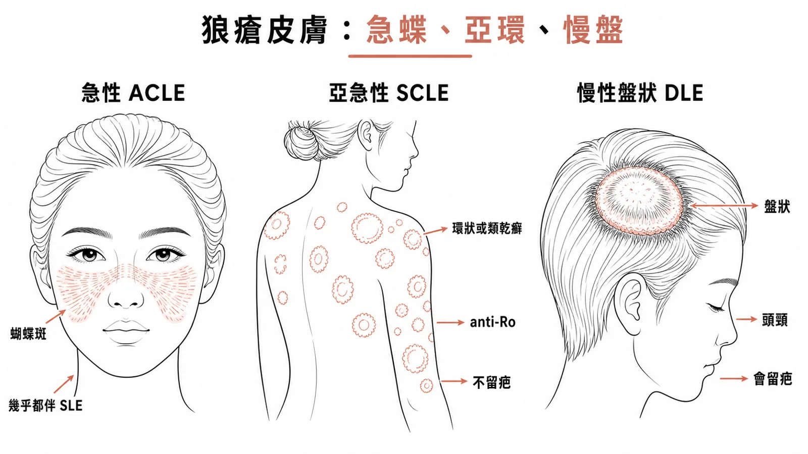 皮膚紅斑性狼瘡三型對照:急性 ACLE 是避開鼻唇溝的臉部蝴蝶斑、幾乎都伴 SLE;亞急性 SCLE 是曬到部位的環狀或類乾癬病灶、anti-Ro/SSA、不留疤;慢性盤狀 DLE 好發頭頸、留疤痕性禿髮與色素改變