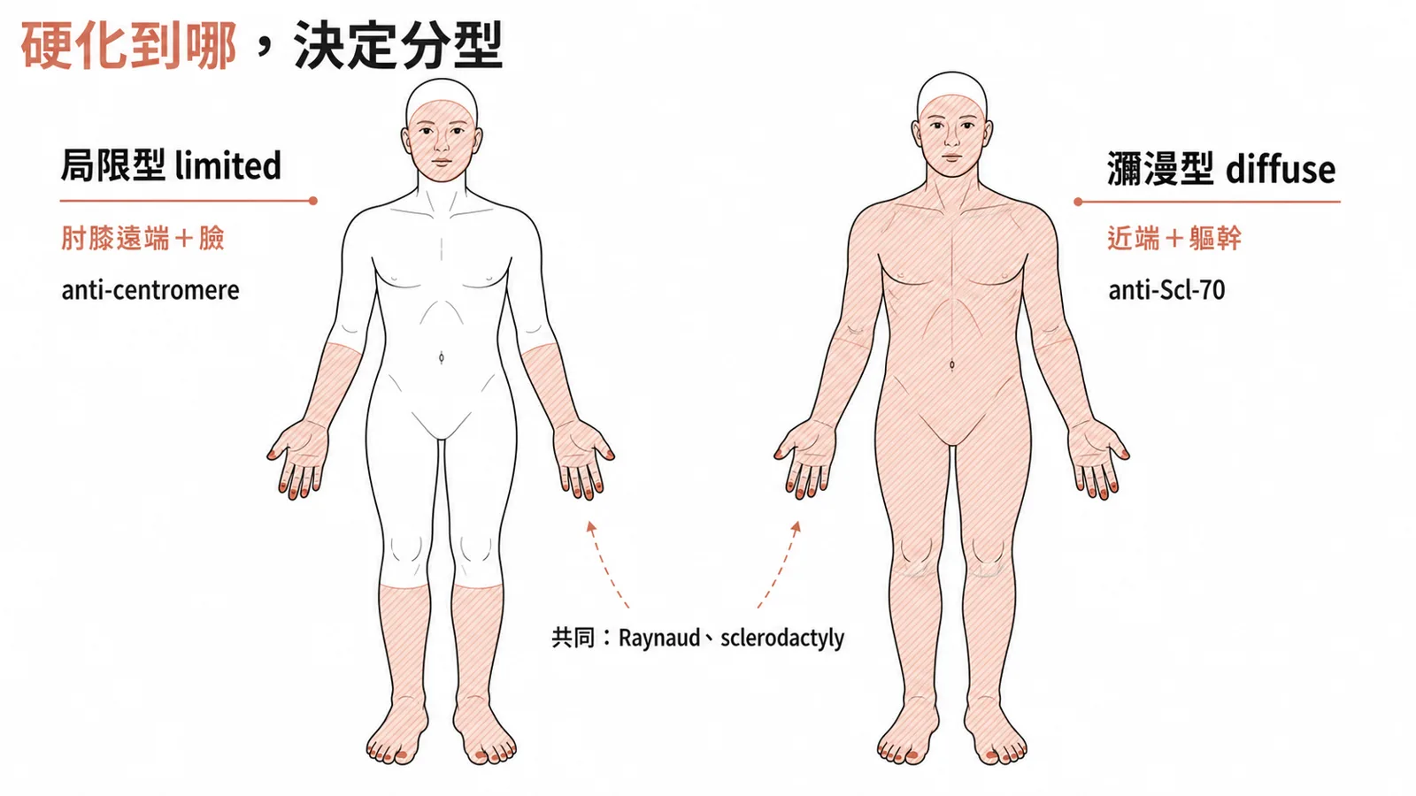 硬皮症局限型與瀰漫型對照:局限型皮膚硬化侷限在肘膝遠端與臉、對應 anti-centromere;瀰漫型波及近端肢體與軀幹、對應 anti-Scl-70;共同有 Raynaud、指端硬化與潰瘍