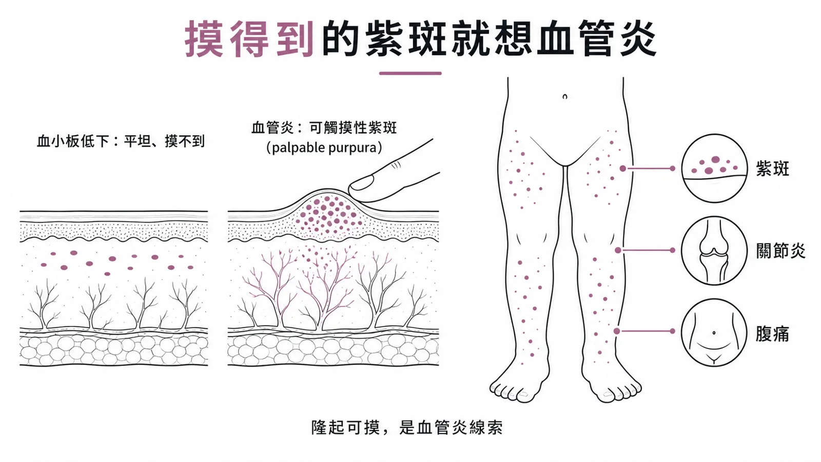 血管炎的可觸摸性紫斑:摸得到、隆起、壓不退色的紫斑代表血管壁發炎(相對於血小板低下的平坦瘀點);IgA 血管炎(HSP)經典三聯是可觸摸性紫斑、關節炎、腹痛,紫斑好發下肢與臀部