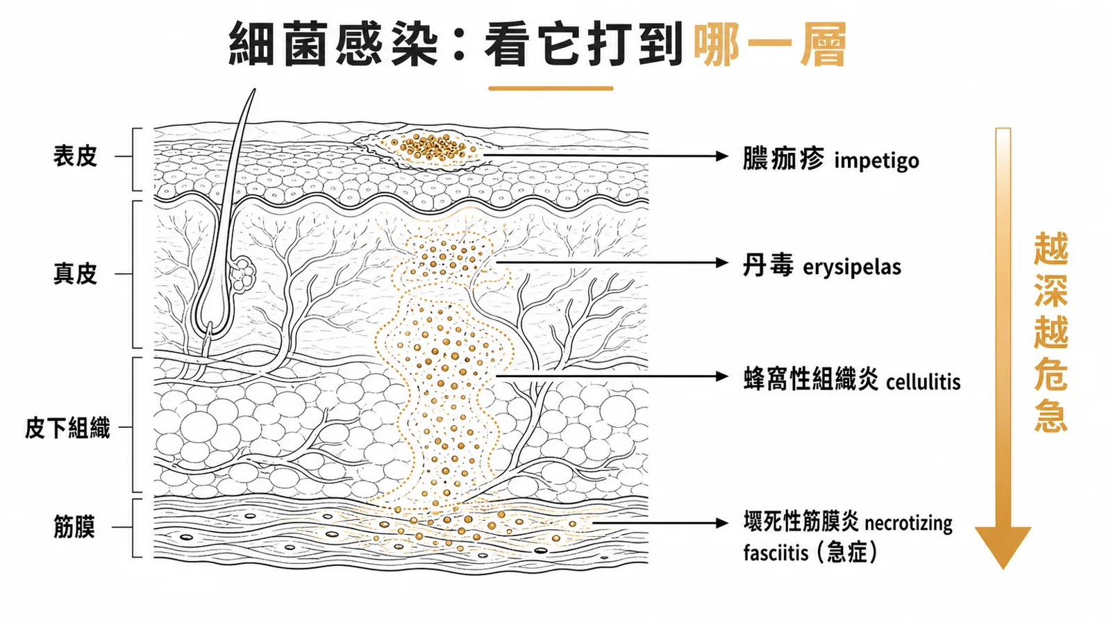 細菌性皮膚感染依侵犯深度分層:膿痂疹在表皮、丹毒在上真皮與淺層淋巴管、蜂窩性組織炎在真皮與皮下、壞死性筋膜炎沿筋膜——越深越危急