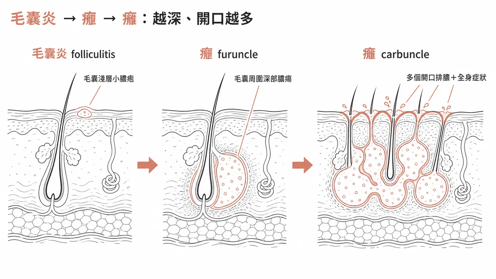 毛囊相關感染由淺入深:毛囊炎是毛囊淺層小膿疱、癤是毛囊周圍深部膿瘍、癰是多個癤融合有多個排膿開口並有全身症狀