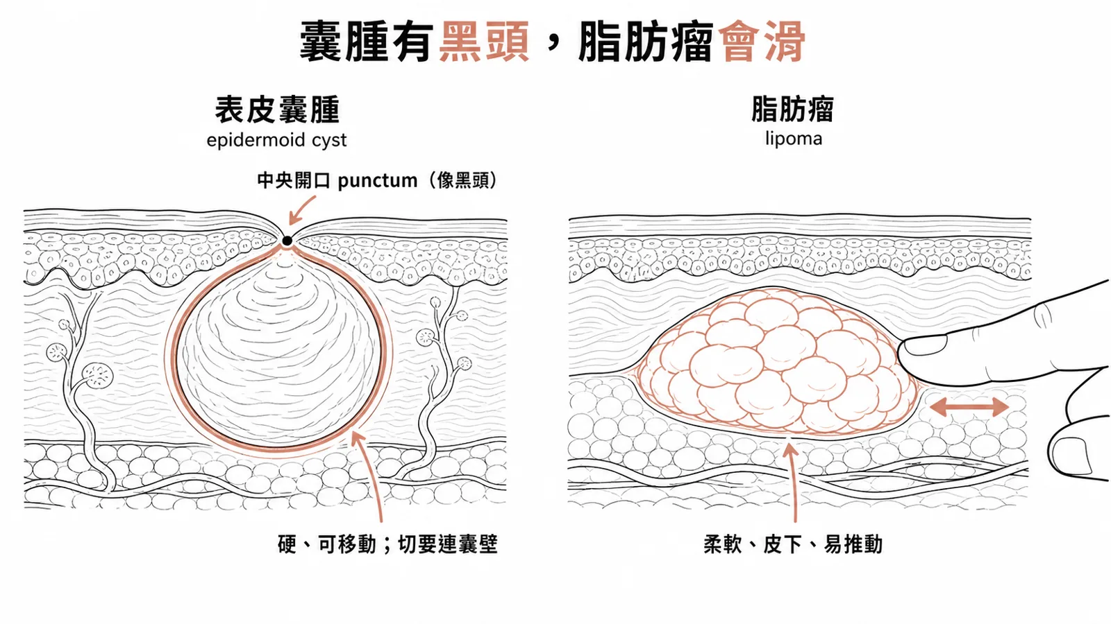 表皮囊腫與脂肪瘤:表皮囊腫是硬、可動、中央有開口(punctum,像黑頭)的表淺結節,發炎先打類固醇再連囊壁切除;脂肪瘤是柔軟、可在皮下輕易推動的腫塊