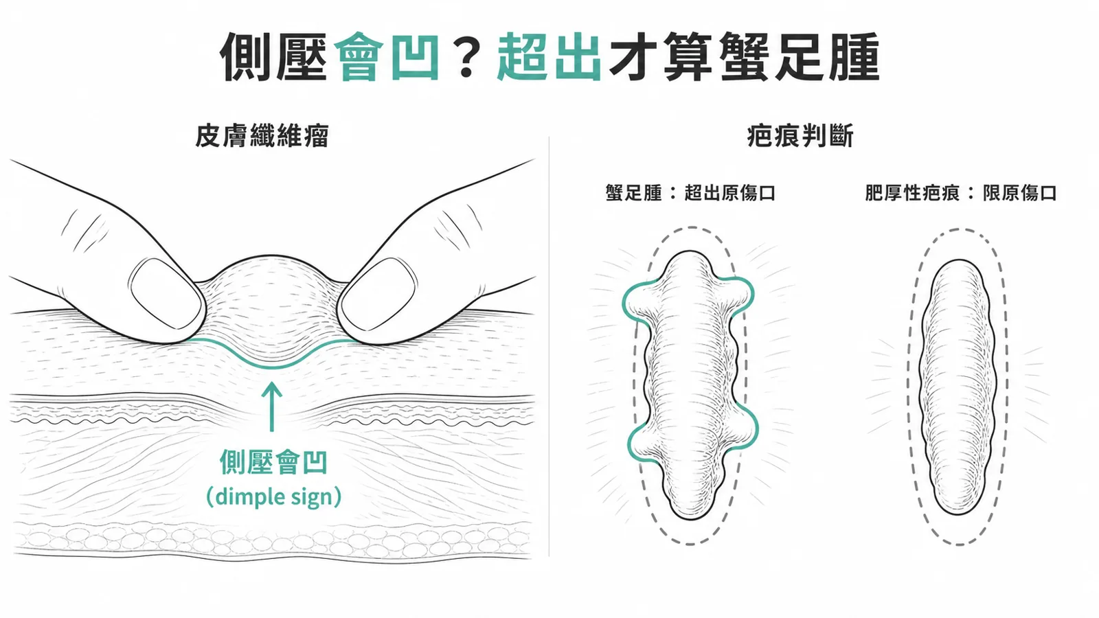 皮膚纖維瘤與疤痕:皮膚纖維瘤側邊擠壓時病灶往皮膚下凹陷(dimple sign/Fitzpatrick sign);蟹足腫是超出原傷口範圍的纖維疤,肥厚性疤痕則限在原傷口內