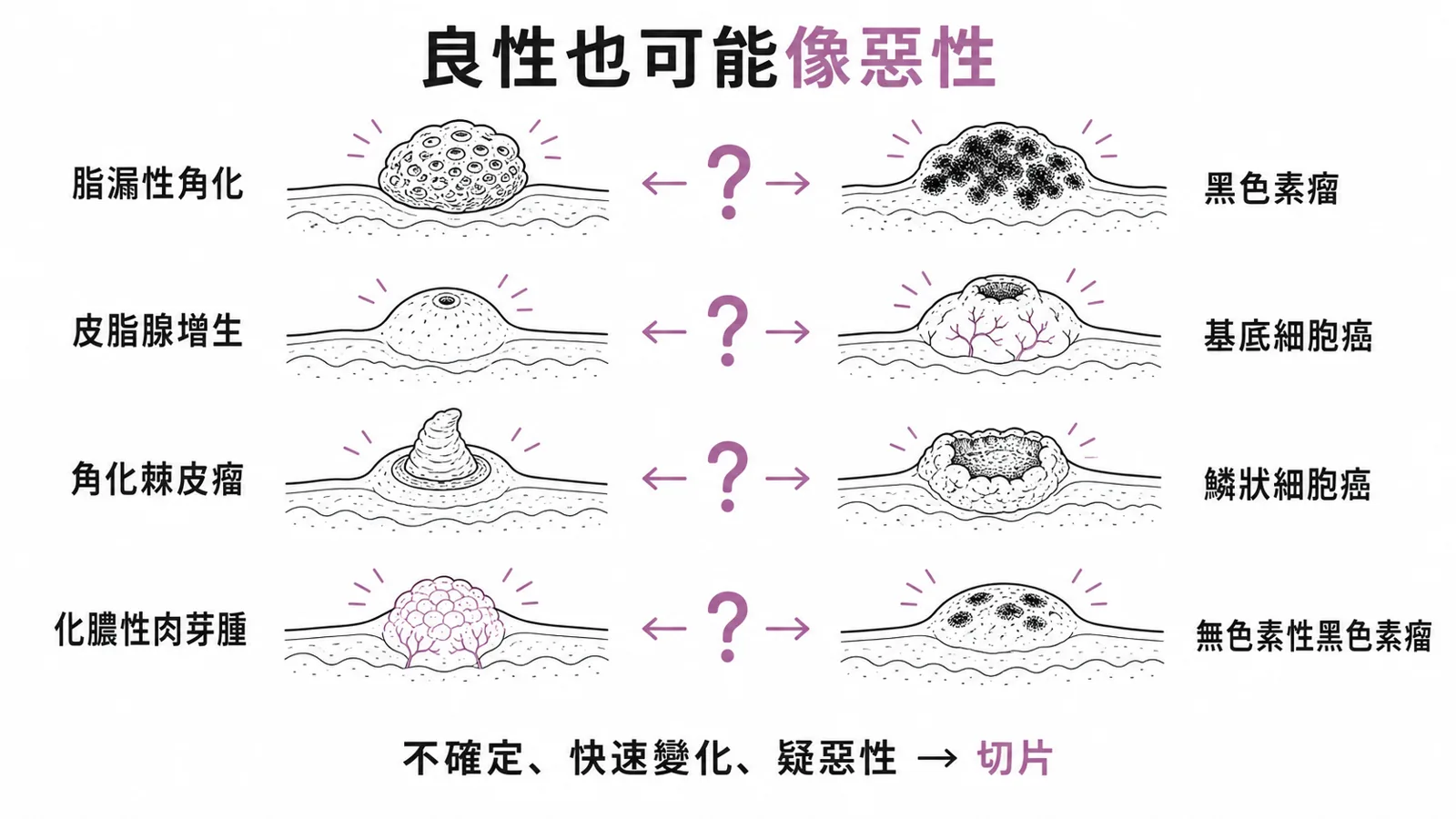 良性皮膚瘤最怕誤認成惡性:脂漏性角化 vs 黑色素瘤、皮脂腺增生 vs 基底細胞癌、角化棘皮瘤 vs 鱗狀細胞癌、化膿性肉芽腫 vs 無色素性黑色素瘤——診斷不確定或快速變化就切片
