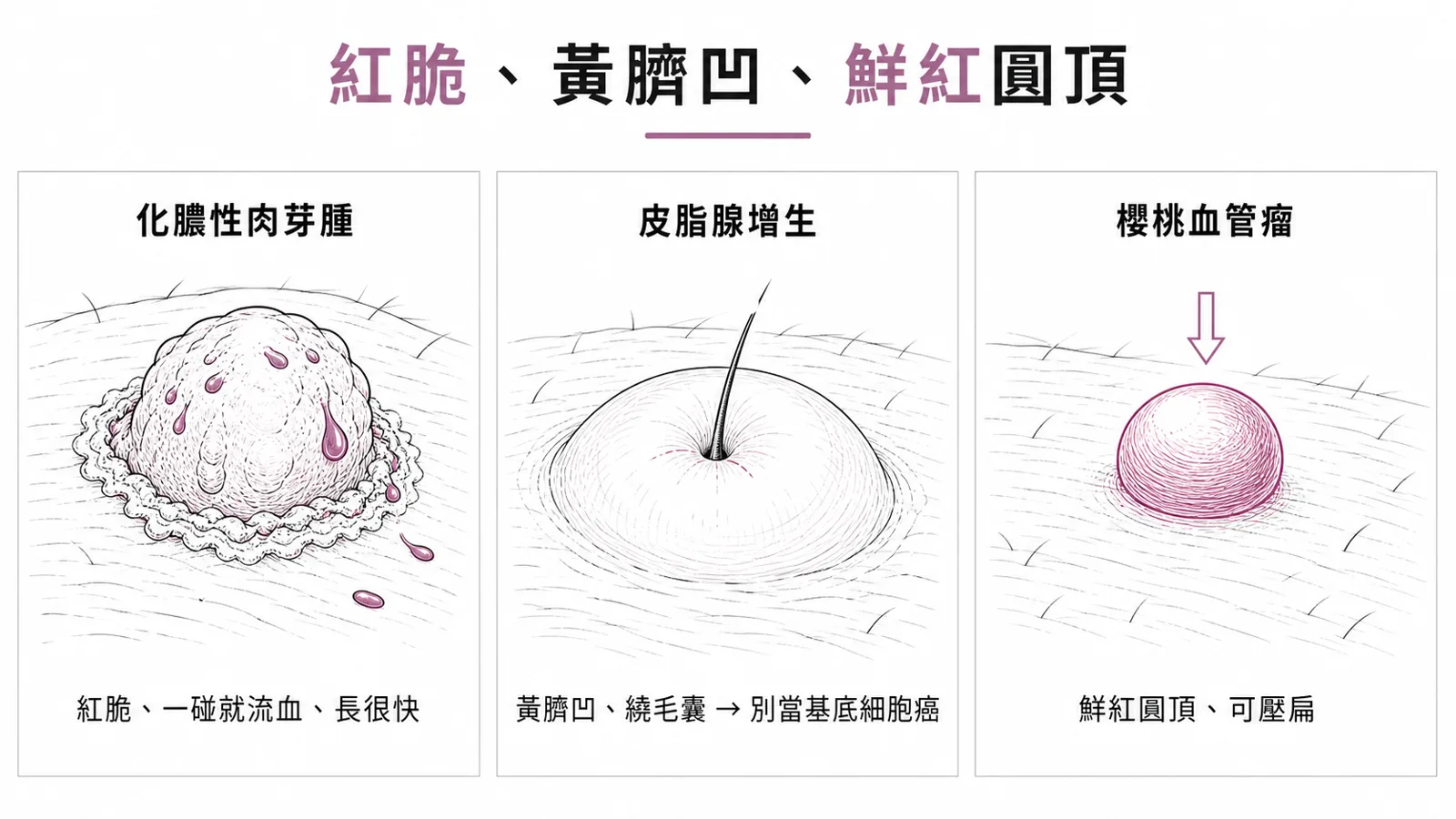 血管與皮脂源良性瘤:化膿性肉芽腫紅脆、一碰就流血、長很快;皮脂腺增生是黃色、中央臍狀凹陷、繞毛囊的丘疹,要和基底細胞癌區分;櫻桃血管瘤是鮮紅圓頂、可壓扁