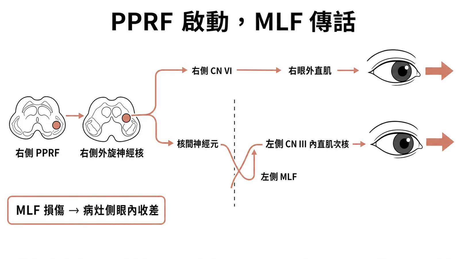 向右水平凝視迴路:右側 PPRF 啟動右側外旋神經核,並經 MLF 連到左側動眼神經核
