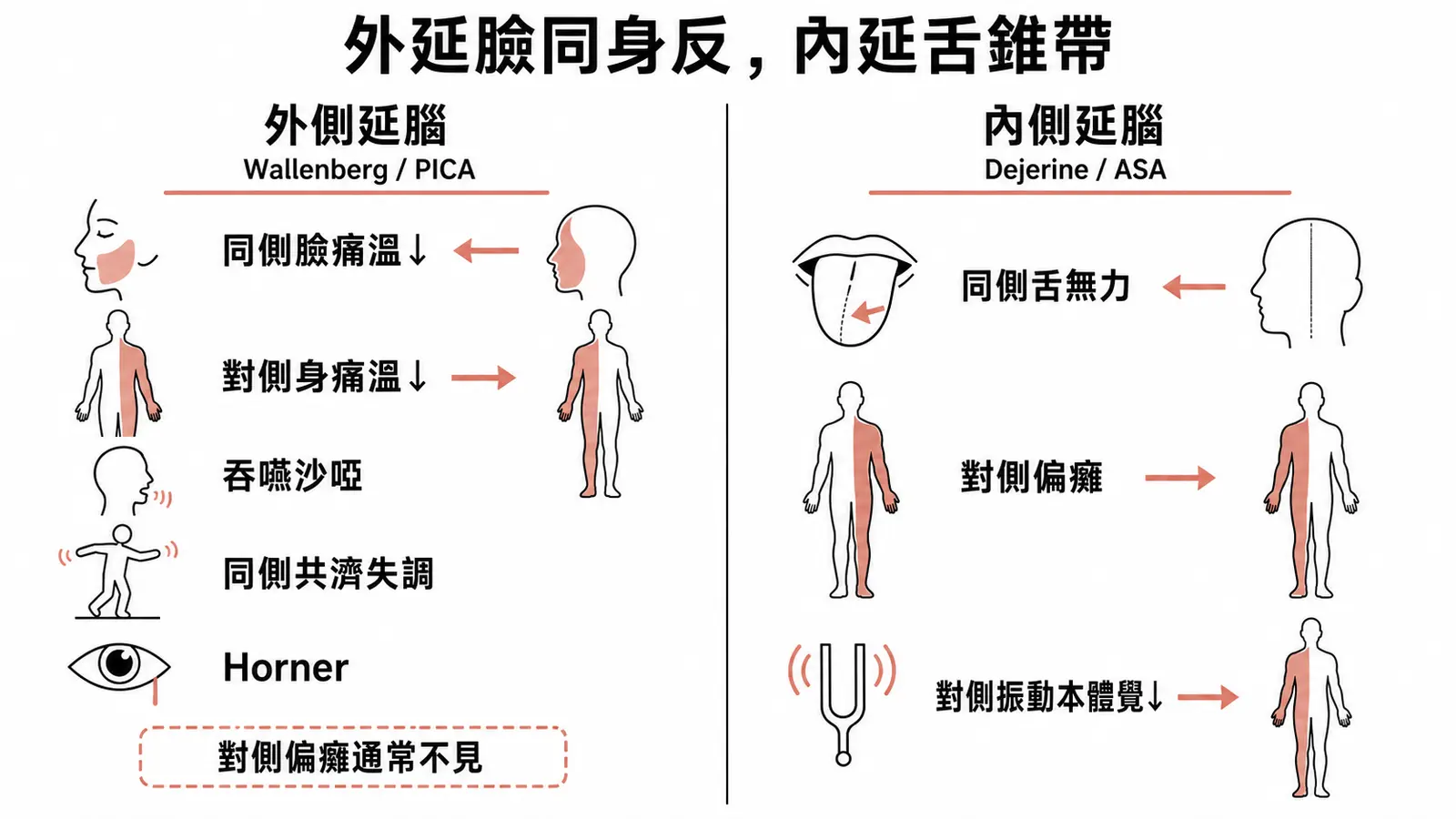 外側與內側延腦症候群對照:Wallenberg 的臉同身反吞嚥難,Dejerine 的舌錐帶三聯徵