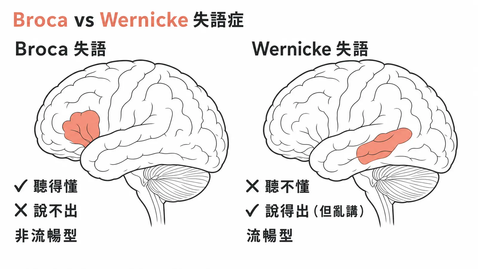 Broca vs Wernicke 失語症:Broca 聽得懂但說不出(非流暢)、Wernicke 說得出但聽不懂(流暢型)