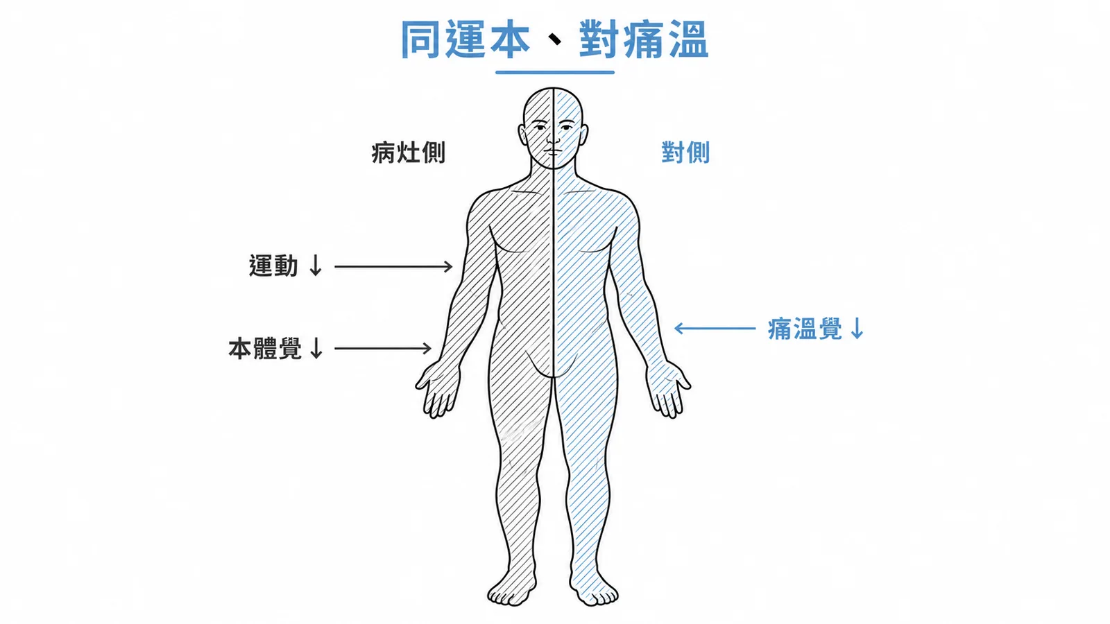 Brown-Séquard 脊髓半切:病灶側運動+本體覺喪失,對側痛溫覺喪失