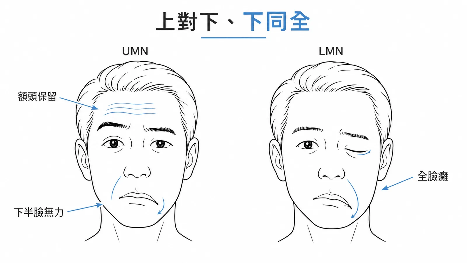 CN VII 定位:UMN 損傷額頭保留只有下半臉無力,LMN 損傷全臉癱