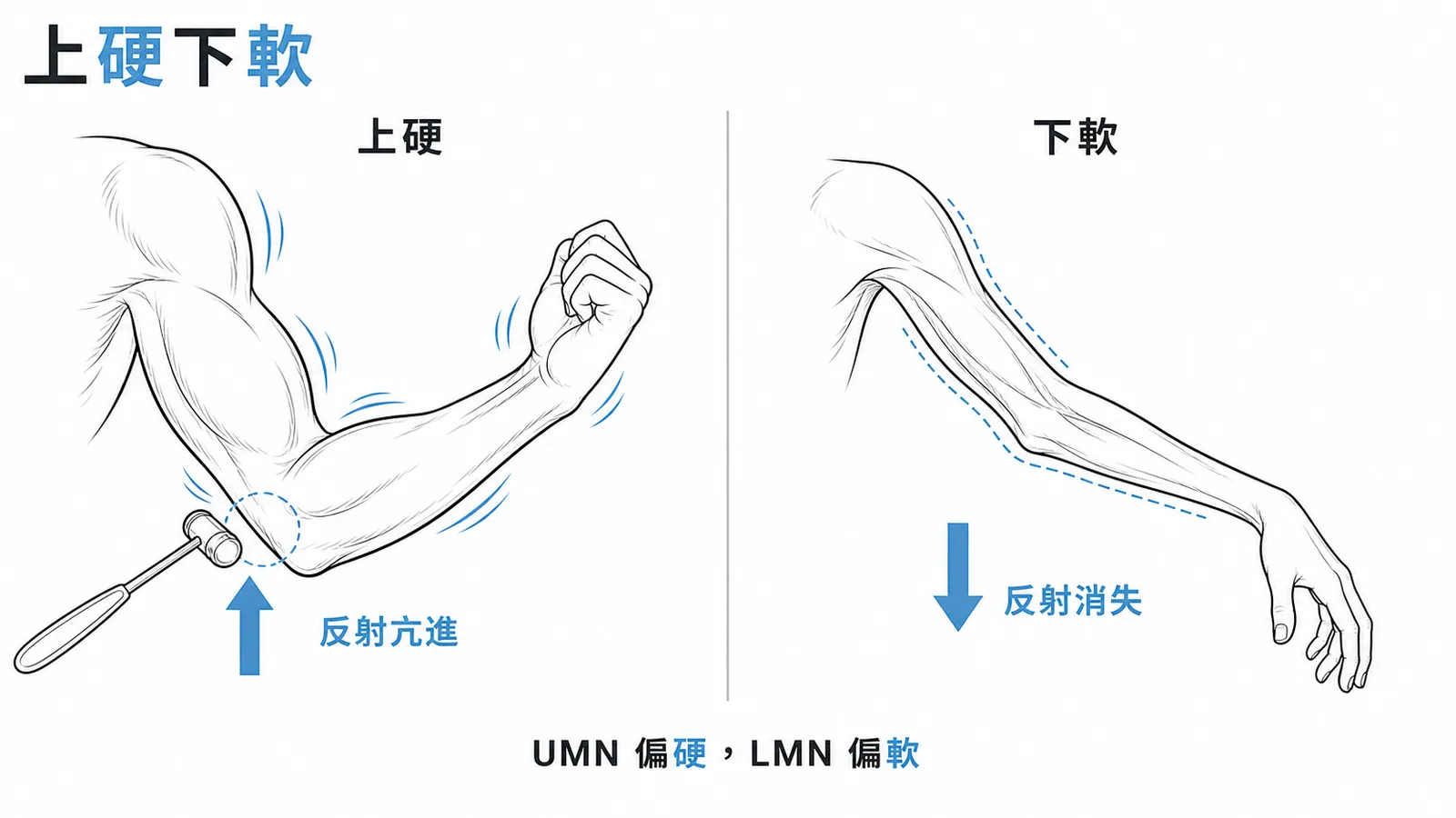 上硬下軟:UMN 損傷肌肉痙攣反射亢進,LMN 損傷肌肉萎縮反射消失