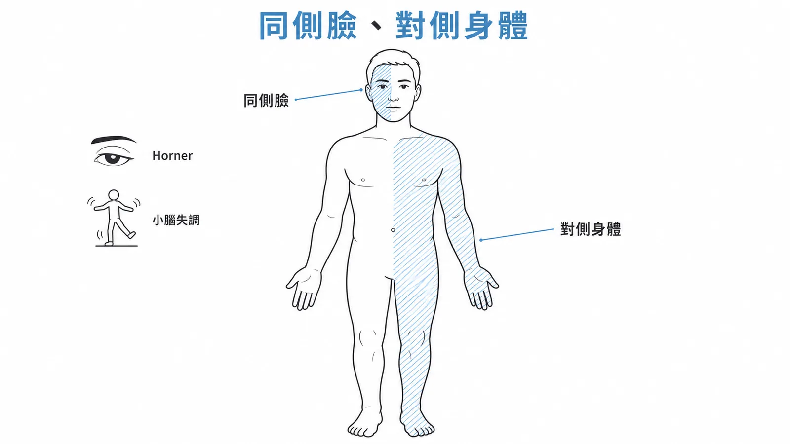 Wallenberg 交叉性感覺喪失:同側臉部痛溫覺喪失+對側身體痛溫覺喪失