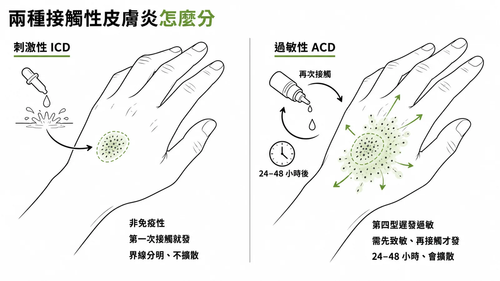 刺激性與過敏性接觸性皮膚炎對照:ICD 是非免疫性、第一次接觸就發、劑量依賴、界線分明限於接觸區;ACD 是第四型遲發過敏、需先致敏、再接觸 24–48 小時才發、可擴散超出接觸區