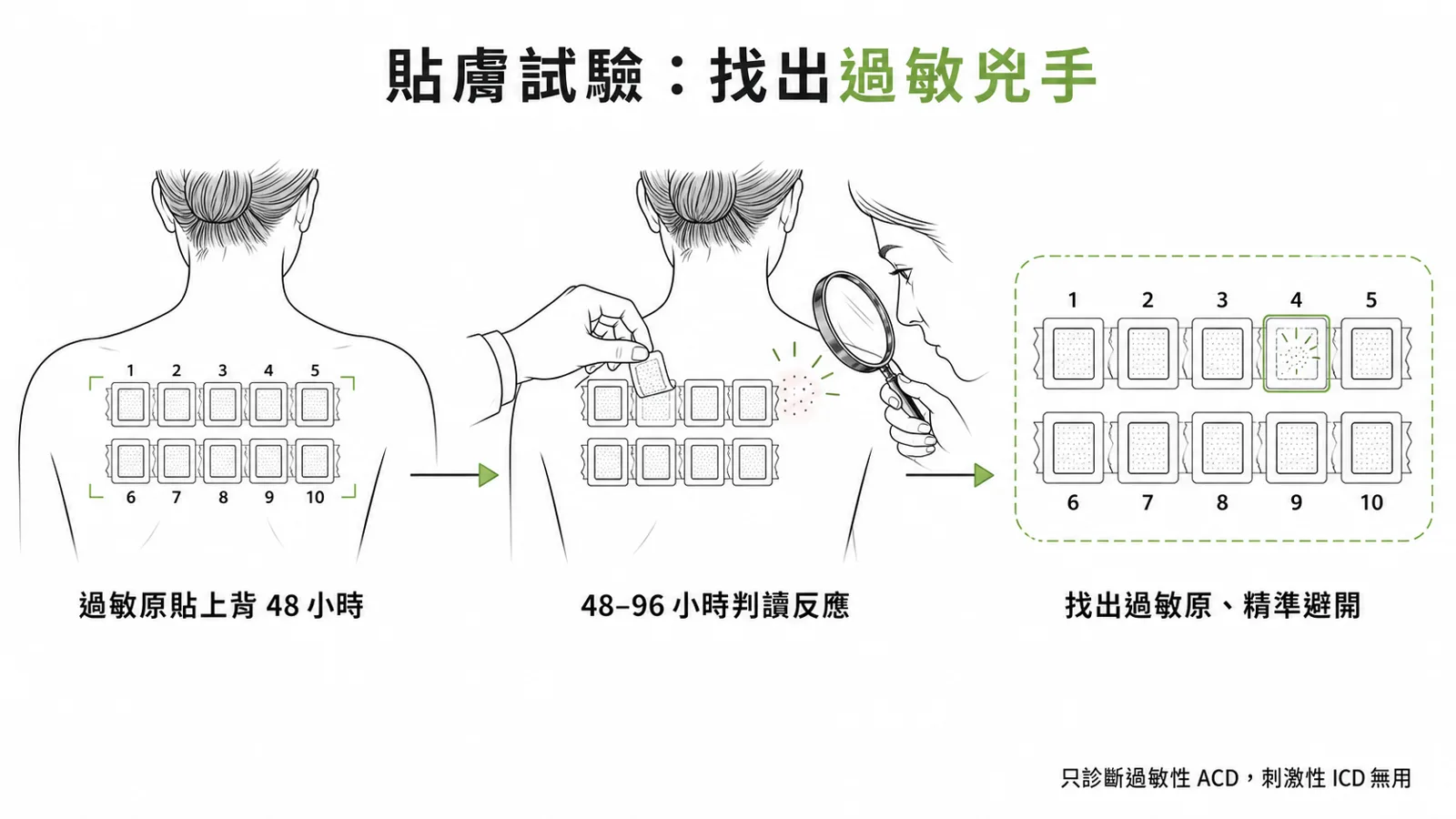 貼膚試驗(patch test)流程:把一系列過敏原貼在上背 48 小時,48 到 96 小時判讀反應,找出對哪個過敏原過敏以精準避開;是過敏性接觸性皮膚炎的診斷 gold standard,對刺激性型無用