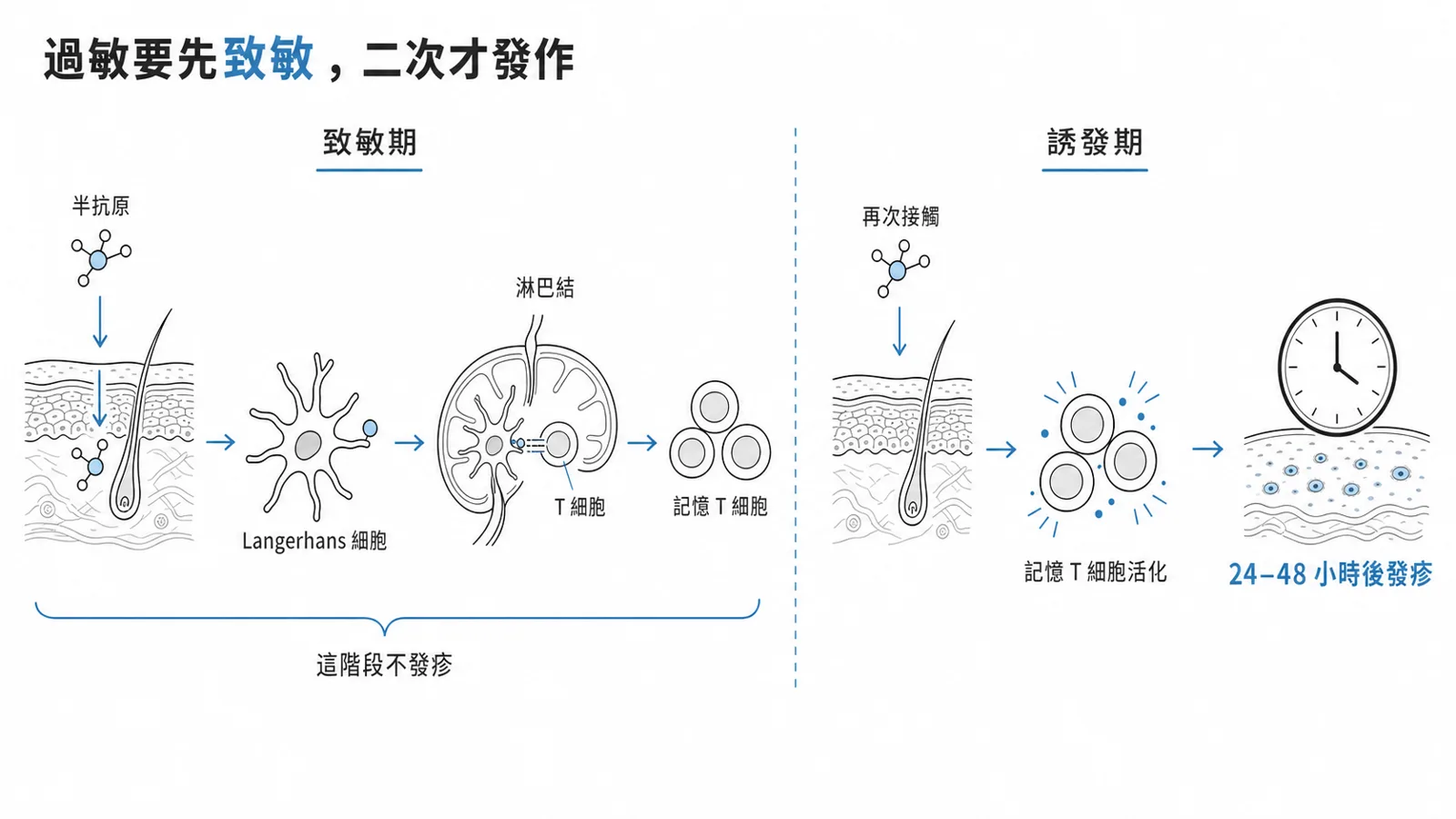 過敏性接觸性皮膚炎第四型過敏兩階段:致敏期由半抗原 hapten 穿透皮膚、Langerhans 細胞呈現給 T 細胞產生記憶 T 細胞(不發疹);誘發期再次接觸同一過敏原、記憶 T 細胞活化,24–48 小時後發疹
