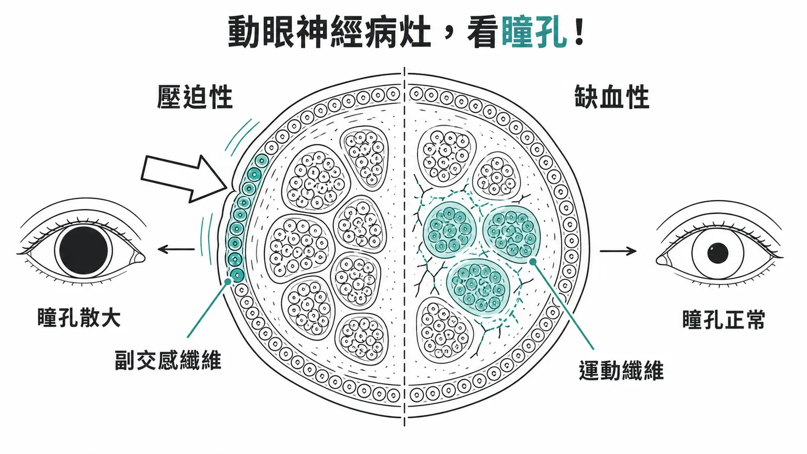 CN III 橫切面：壓迫性病灶先壓外圍副交感纖維導致散瞳，缺血性病灶影響中心運動纖維但瞳孔正常