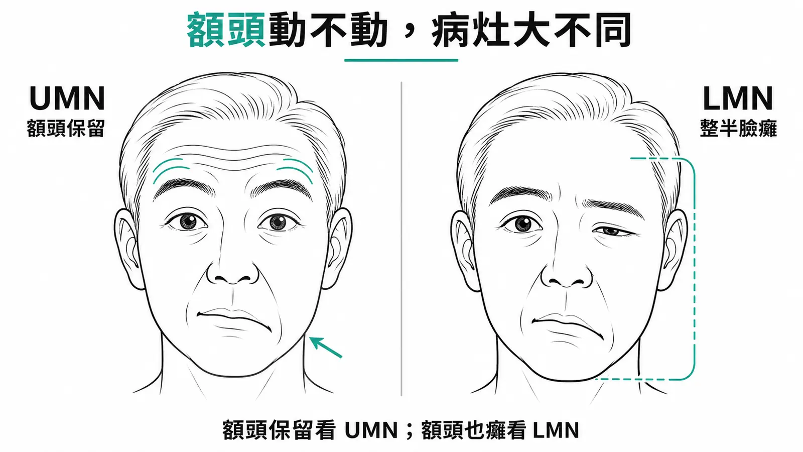 UMN vs LMN 顏面麻痺對照：UMN 額頭保留只下臉癱，LMN 整半臉含額頭都癱