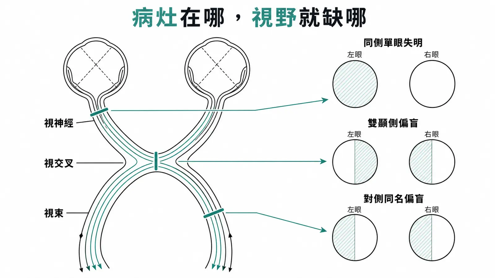視覺路徑與三種視野缺損：視交叉前單眼失明、視交叉雙顳側偏盲、視交叉後同名偏盲