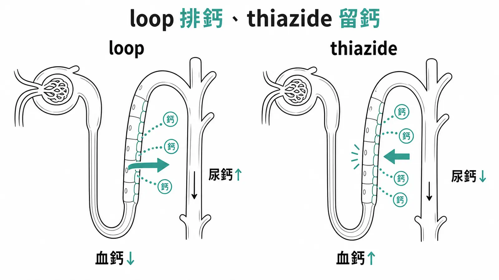 利尿劑尿鈣相反:loop 增尿鈣治高血鈣、thiazide 減尿鈣治高鈣尿與腎結石