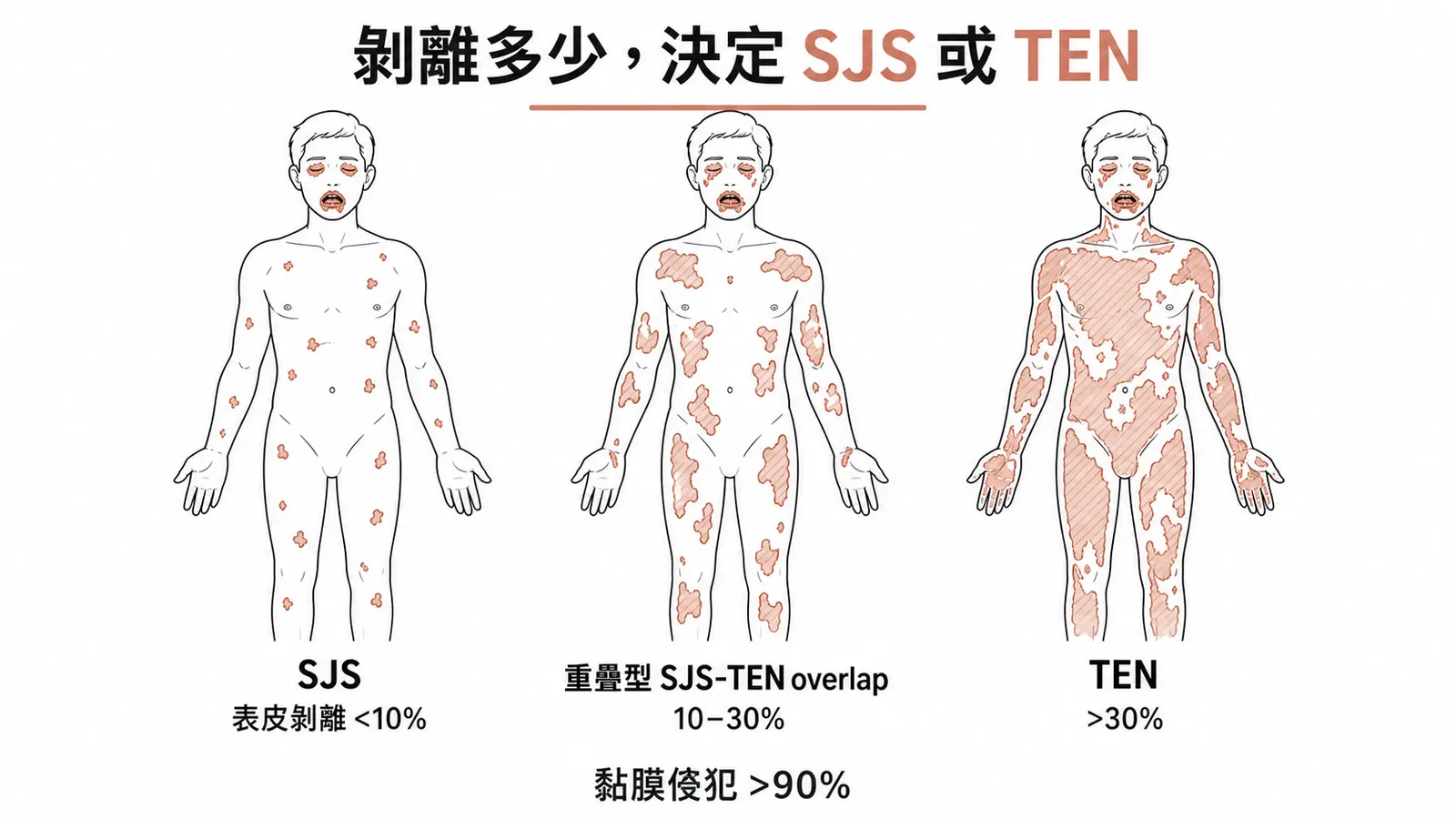 SJS 與 TEN 依表皮剝離體表面積分界:小於 10% 是 Stevens-Johnson syndrome、10 到 30% 是重疊型、大於 30% 是毒性表皮壞死溶解症;黏膜侵犯超過 90%