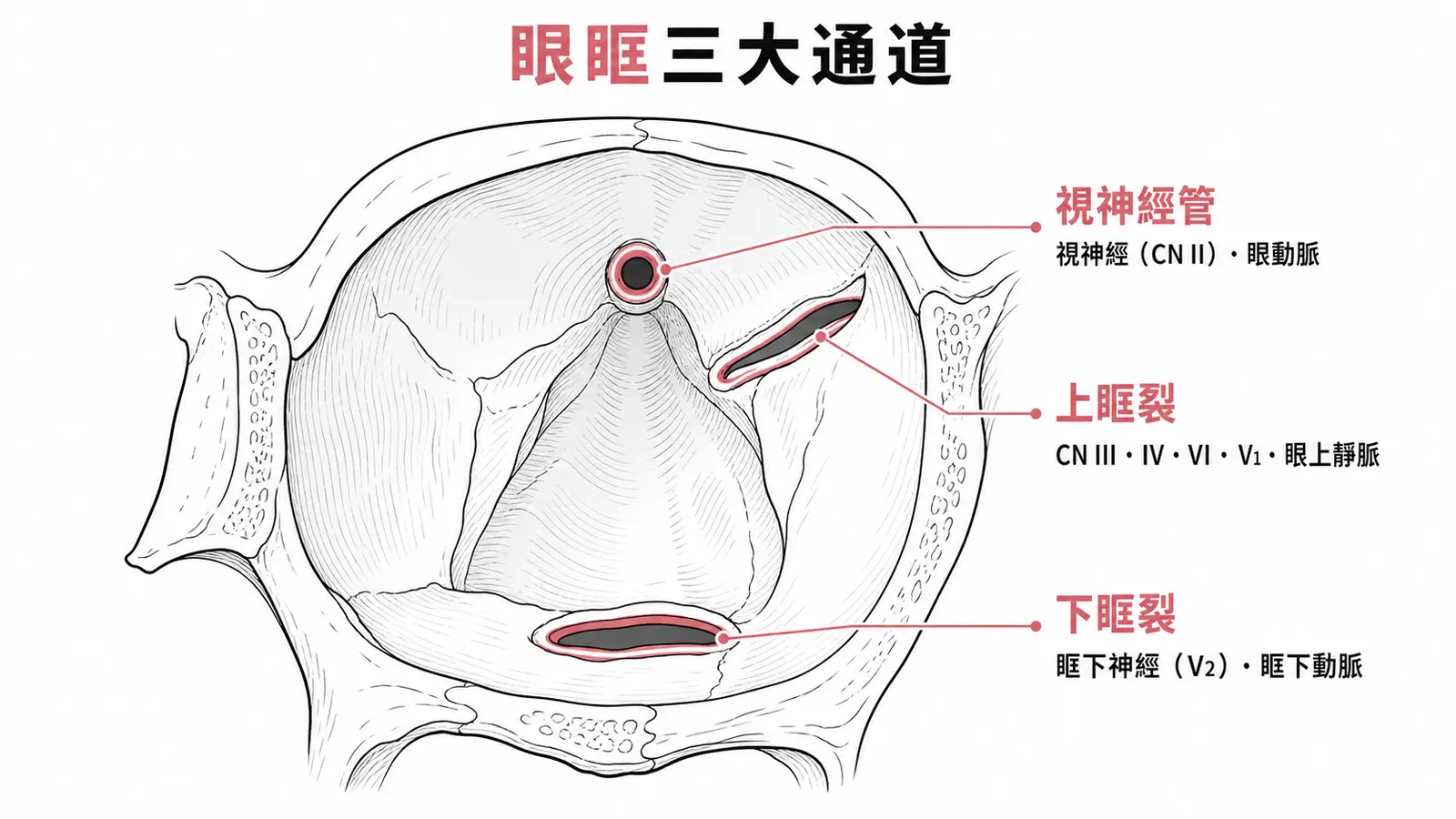 眼眶三大通道示意圖:視神經管(CN II+眼動脈)、上眶裂(CN III/IV/VI/V1)、下眶裂(V2+眶下動脈)