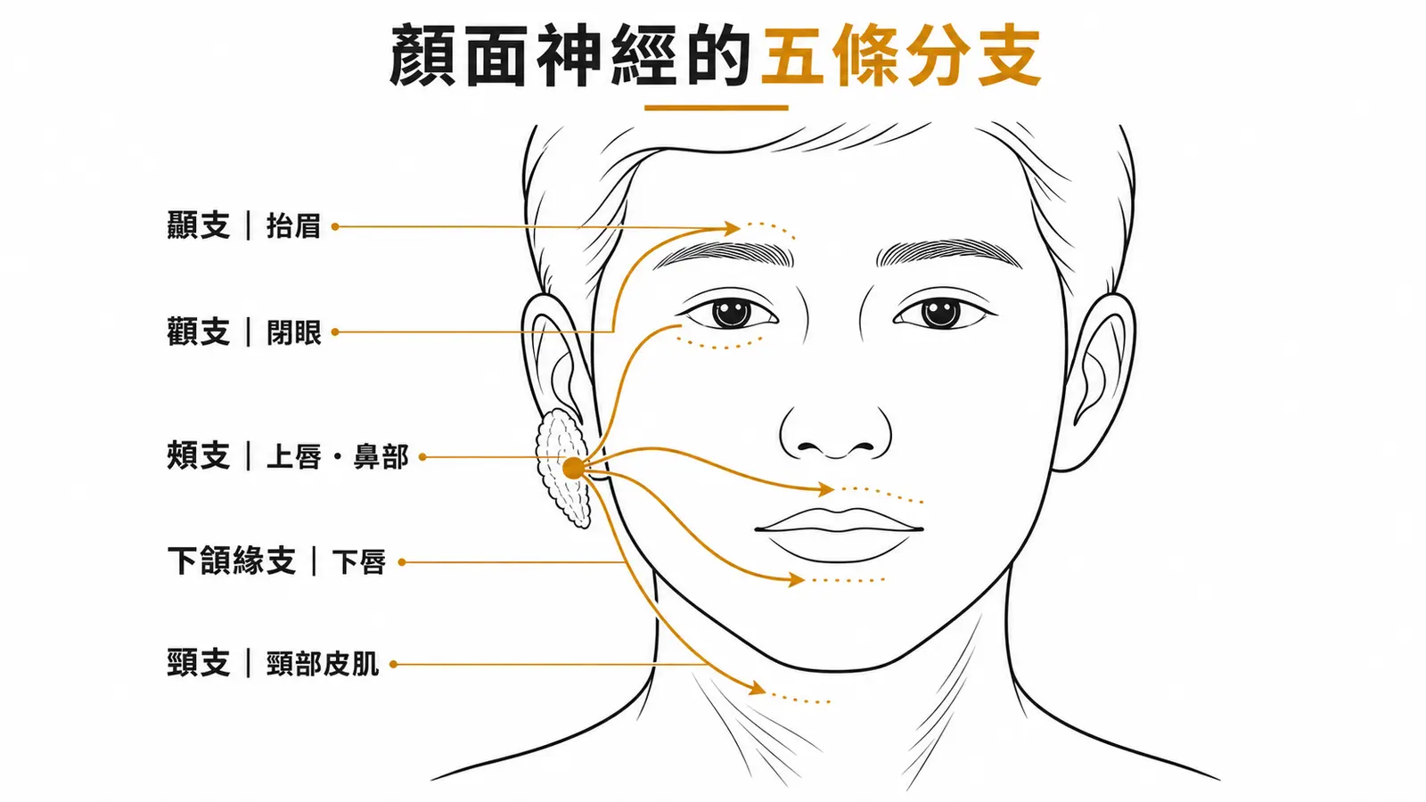顏面神經五分支示意圖：CN VII 從腮腺分出 Temporal、Zygomatic、Buccal、Marginal mandibular、Cervical 五條分支分布到臉部各區域