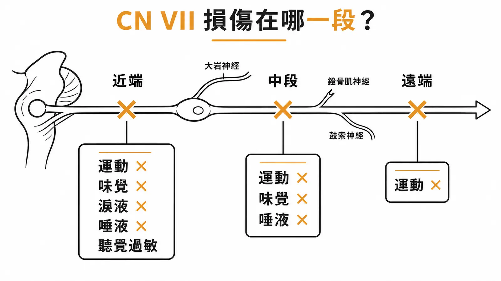 CN VII 損傷三段式定位圖：近端全失、中段部分失、遠端只失運動，缺損功能從左到右漸減