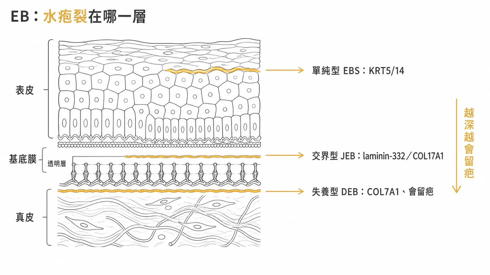 表皮鬆解水疱症 EB 四型依裂解層分：單純型在表皮內（KRT5/14）、交界型在 lamina lucida（laminin-332/COL17A1）、失養型在真皮上層（COL7A1、會留疤）、Kindler 混合型