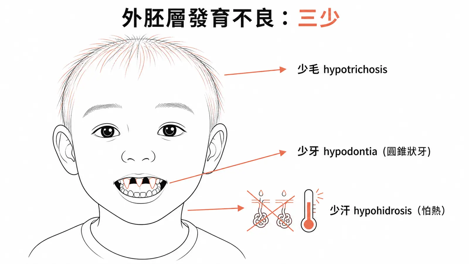 少汗型外胚層發育不良的經典三少：少毛（hypotrichosis 稀疏頭髮）、少牙（hypodontia 缺牙或圓錐狀牙）、少汗（hypohidrosis 汗腺少、怕熱）