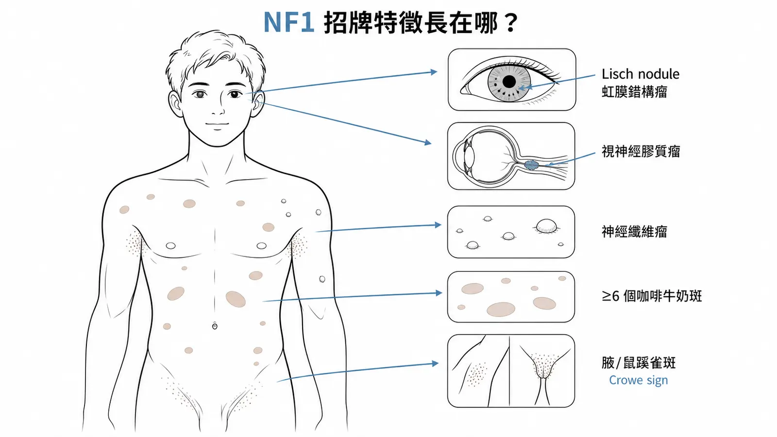 神經纖維瘤病第一型 NF1 的診斷皮膚與眼部特徵：6 個以上咖啡牛奶斑、腋下與鼠蹊部雀斑（Crowe sign）、多個神經纖維瘤、虹膜的 Lisch nodule、視神經膠質瘤