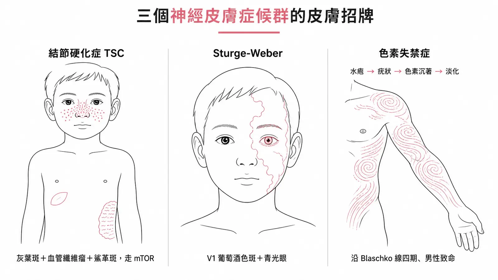 三個神經皮膚症候群的皮膚標記：結節硬化症有灰葉斑、臉部血管纖維瘤與鯊革斑；Sturge-Weber 有三叉神經 V1 分布的葡萄酒色斑；色素失禁症皮疹沿 Blaschko 線分四期