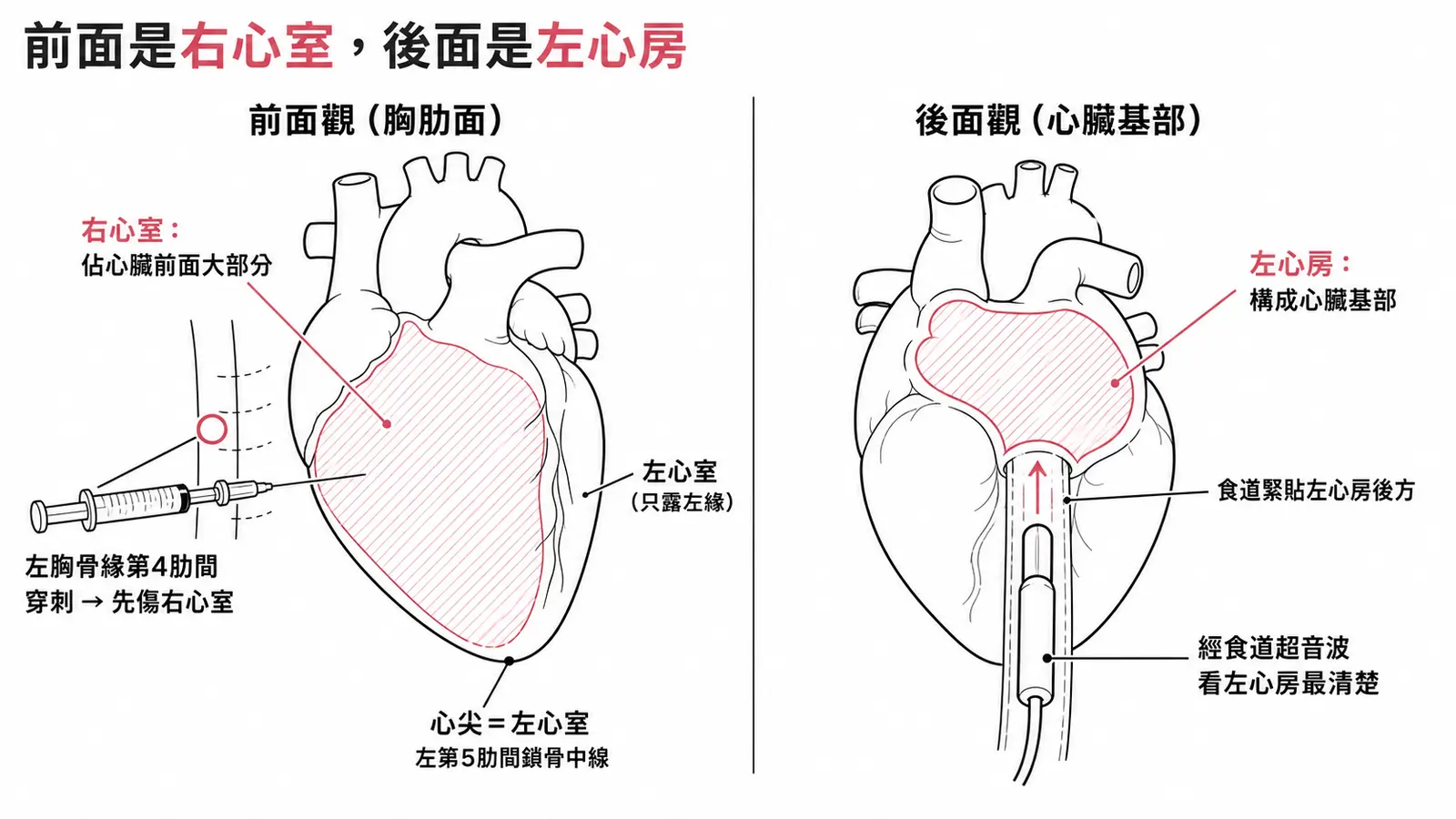 心臟前後面觀對照:心臟前面(胸肋面)大部分是右心室,所以胸骨左緣第4肋間穿刺先傷右心室;心臟基部由左心房構成,正後方緊貼食道,經食道超音波看左心房最清楚