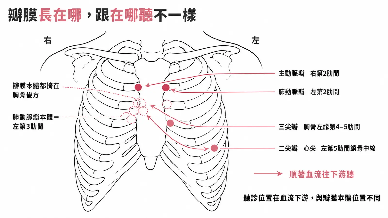 心臟瓣膜的體表投影與聽診位置對照:四個瓣膜本體都擠在胸骨後方,聽診位置在血流下游——主動脈瓣右第2肋間、肺動脈瓣左第2肋間、三尖瓣胸骨左緣第4–5肋間、二尖瓣心尖左第5肋間鎖骨中線;肺動脈瓣本體則在左第3肋間