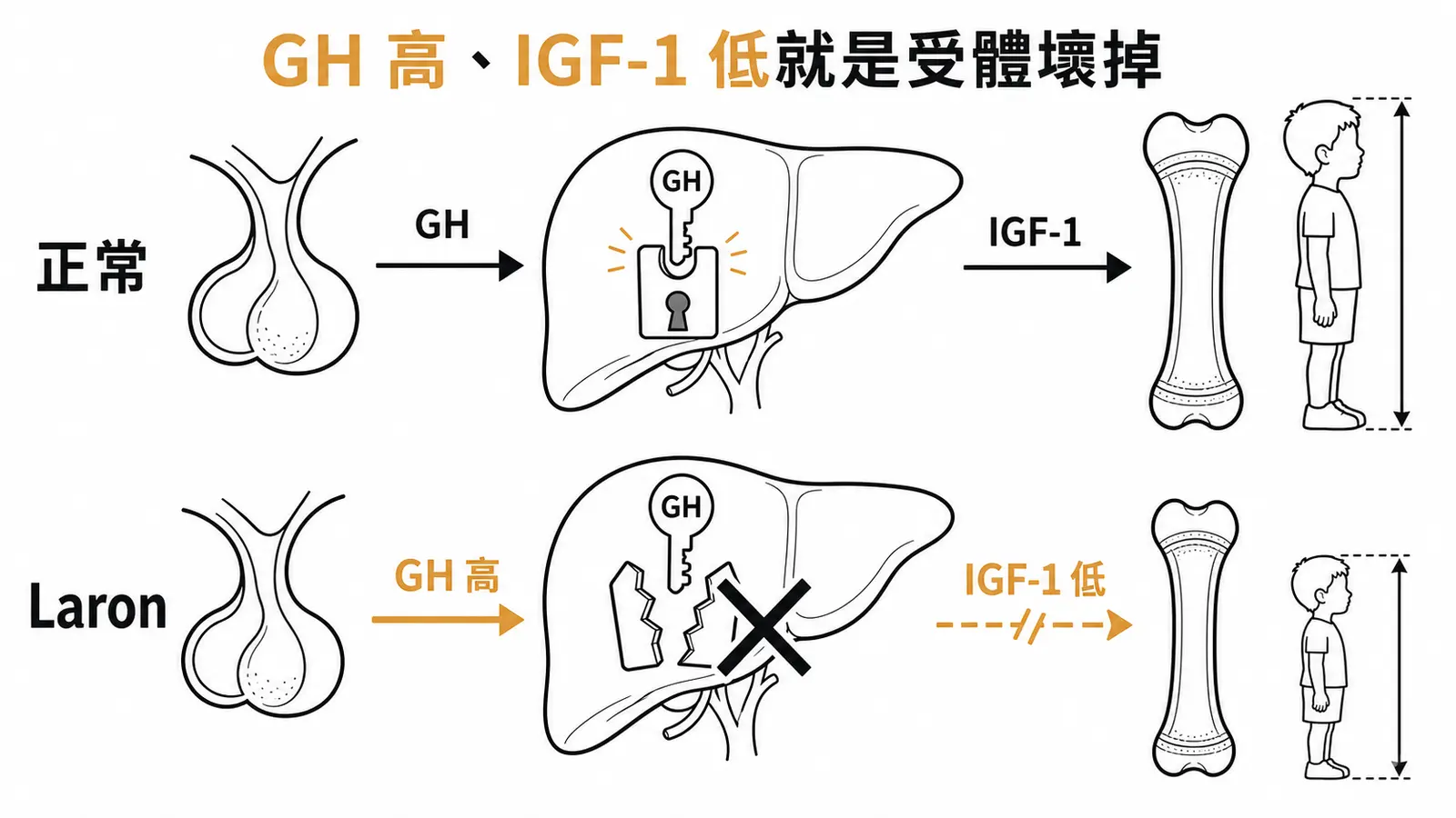 正常時 GH 作用於肝臟受體產生 IGF-1 促進生長；Laron syndrome 肝臟 GH 受體缺損，GH 高但 IGF-1 低、身材矮小