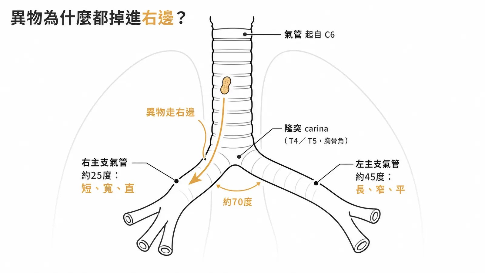 氣管與支氣管樹線稿：氣管起自C6、隆突位於T4／T5，右主支氣管約25度短寬直、左主支氣管約45度長窄平，異物優先掉進右側