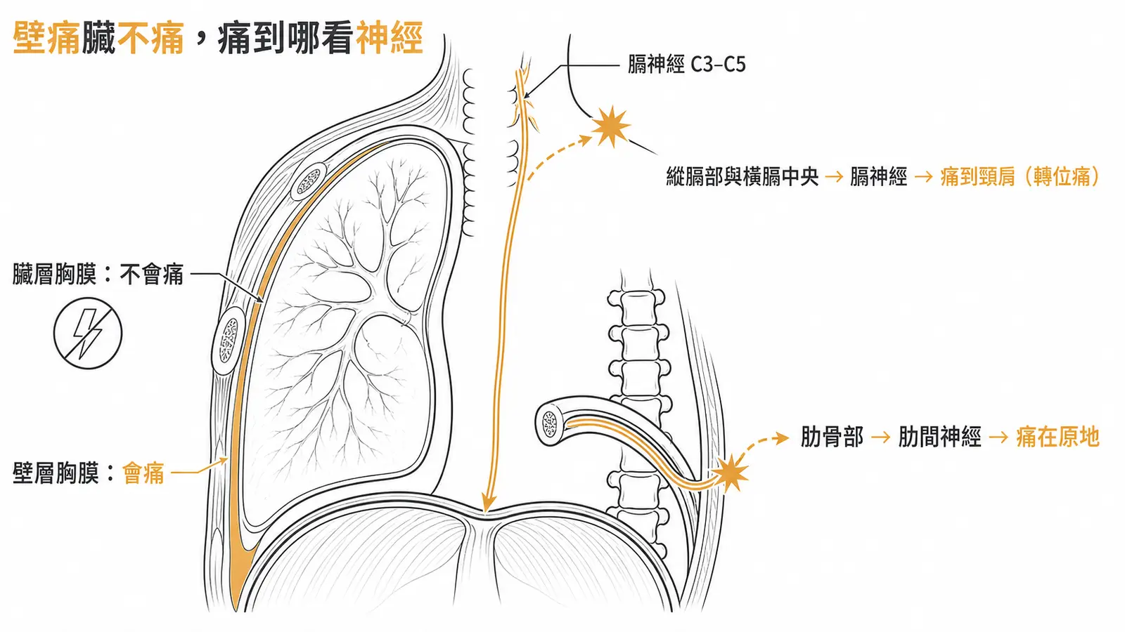胸膜神經支配示意圖：臟層胸膜不會痛，壁層胸膜會痛；肋骨部經肋間神經痛在原地，縱膈部與橫膈中央經膈神經C3–C5轉位痛到頸肩