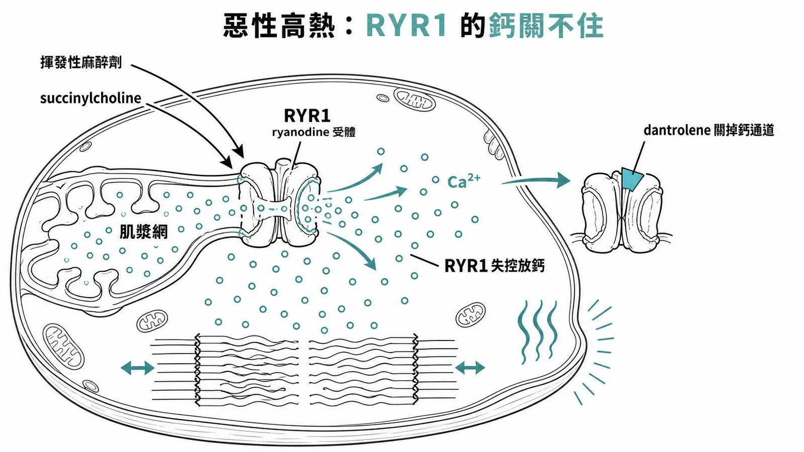 惡性高熱機轉:揮發性麻醉劑或 succinylcholine 觸發帶 RYR1 突變的病人,骨骼肌肌漿網的鈣離子釋放通道失控外漏鈣、肌肉持續收縮產熱,解藥 dantrolene 直接關掉這個通道