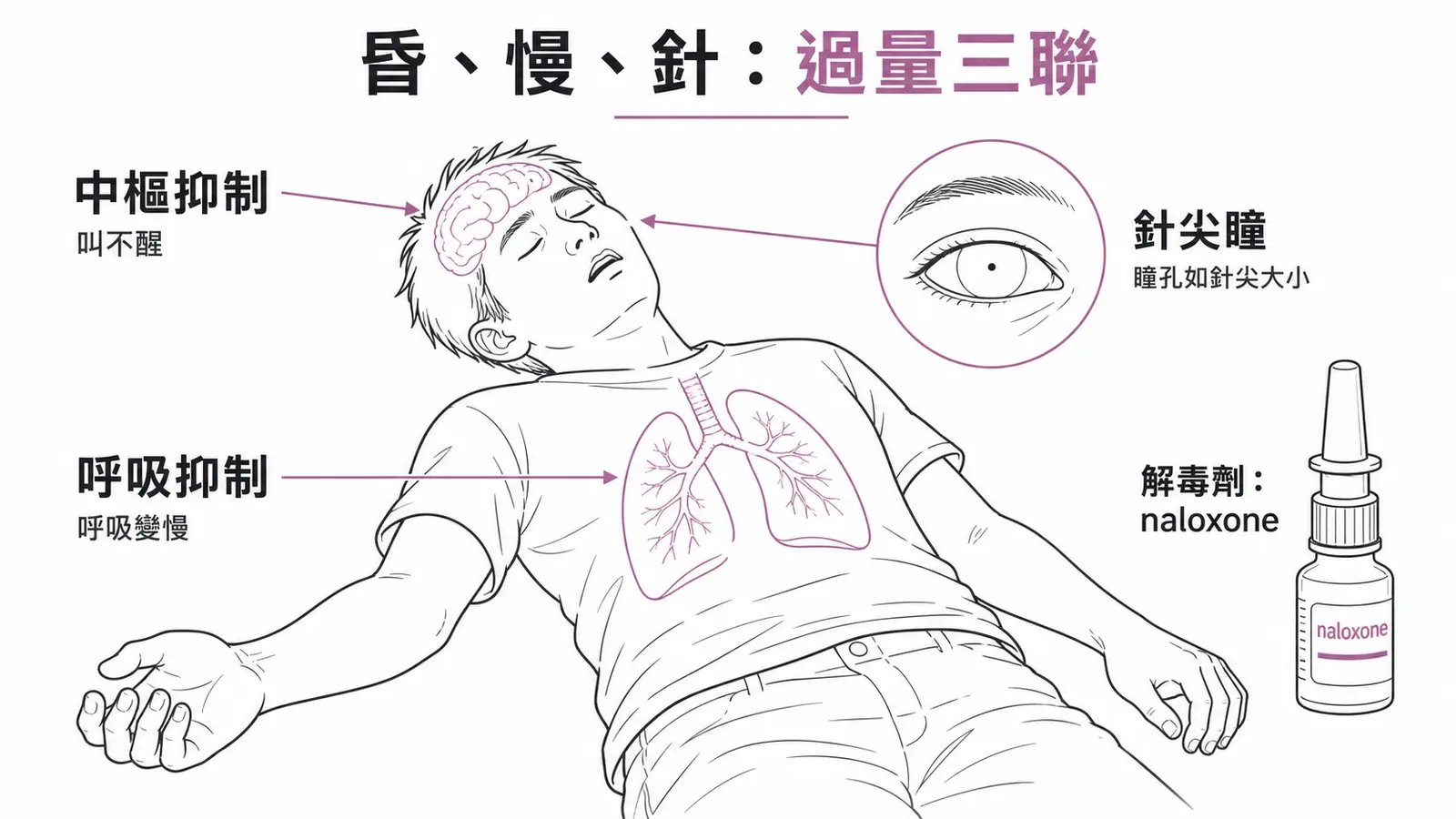 鴉片過量三聯:中樞抑制(昏睡)、呼吸抑制(呼吸變慢)、針尖瞳(miosis);解毒打 naloxone
