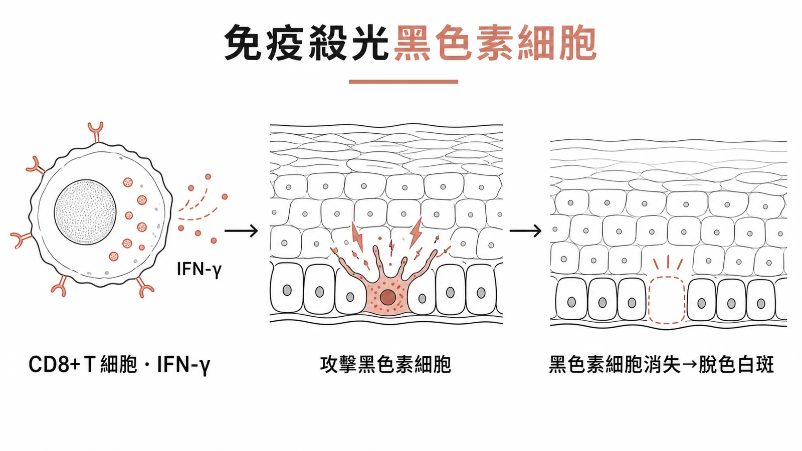 白斑病生理:自體反應性 CD8+T 細胞經 IFN-γ 攻擊並破壞表皮黑色素細胞,黑色素細胞消失導致皮膚脫色
