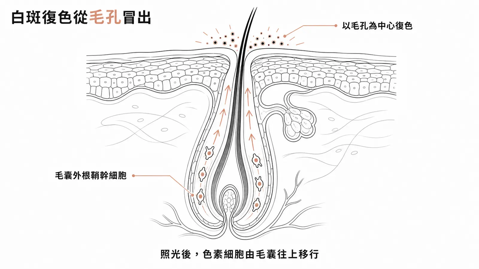 白斑照光復色來源:毛囊外根鞘的黑色素幹細胞被活化,沿毛幹上移到表皮,形成以毛孔為中心的復色