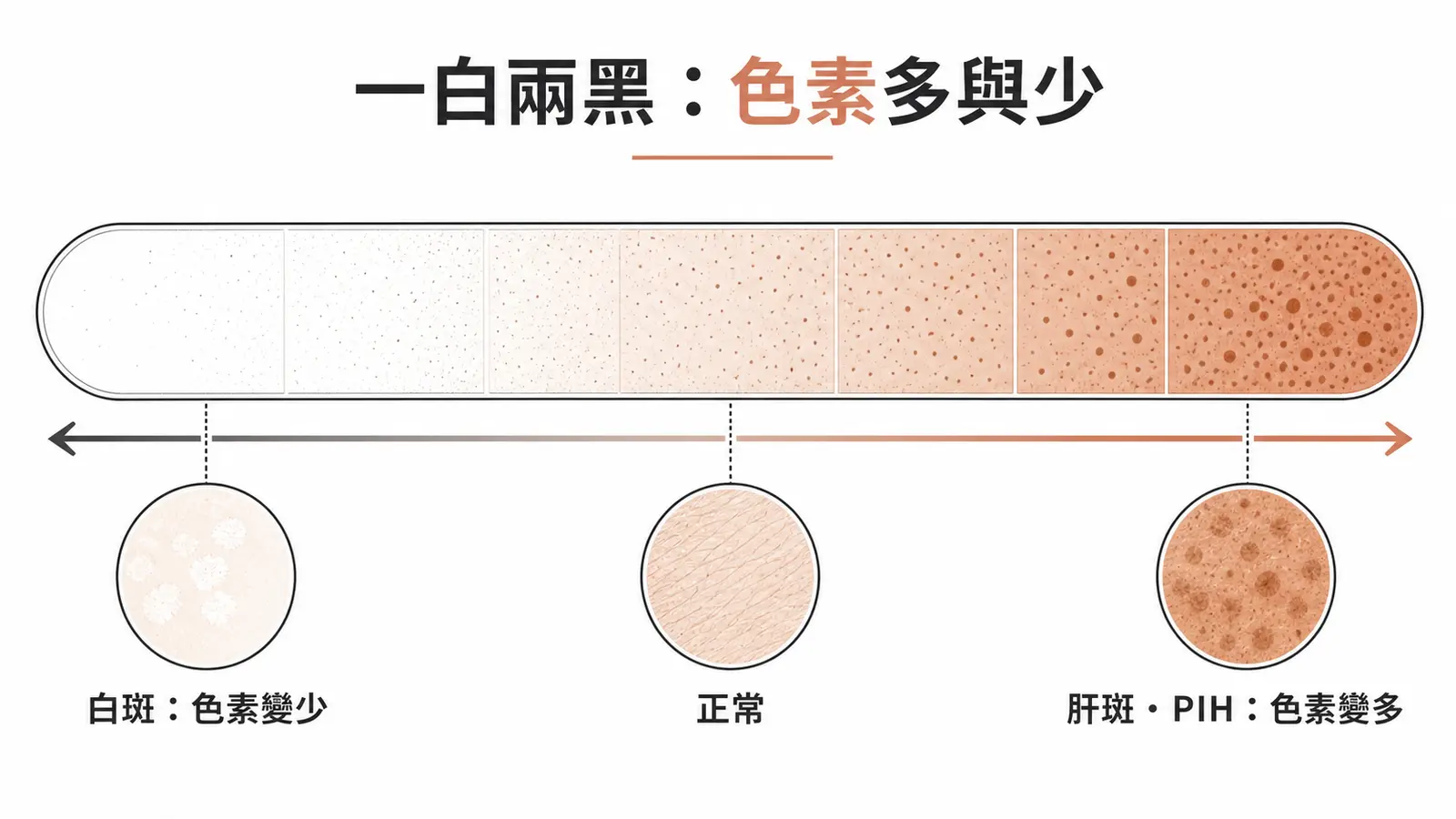 色素異常兩方向:白斑為色素減少(變白),肝斑與發炎後色素沉著為色素增多(變褐)