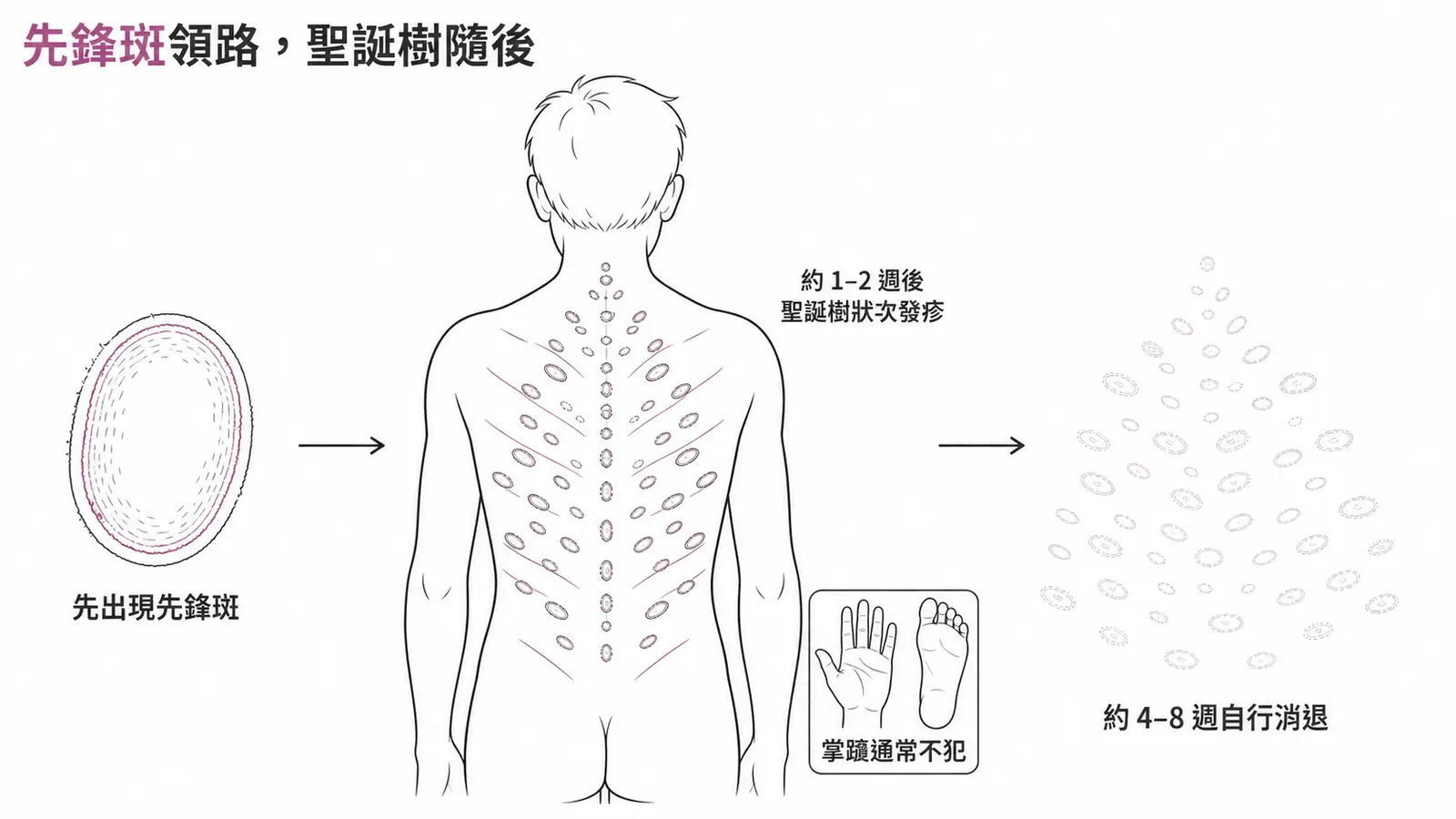 玫瑰糠疹典型病程時間軸:先出現單一先鋒斑,約 1 到 2 週後軀幹沿皮膚張力線冒出聖誕樹狀次發疹,約 4 到 8 週自行消退,手掌腳掌通常不犯