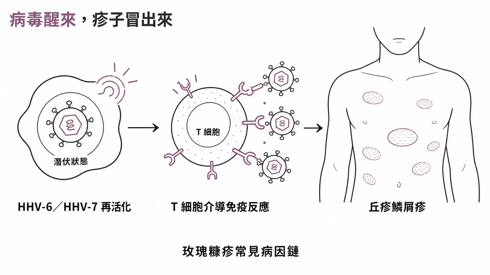 玫瑰糠疹病因流程:人類疱疹病毒第六型與第七型(HHV-6、HHV-7)再活化,引發 T 細胞介導的免疫反應,造成軀幹的丘疹鱗屑疹