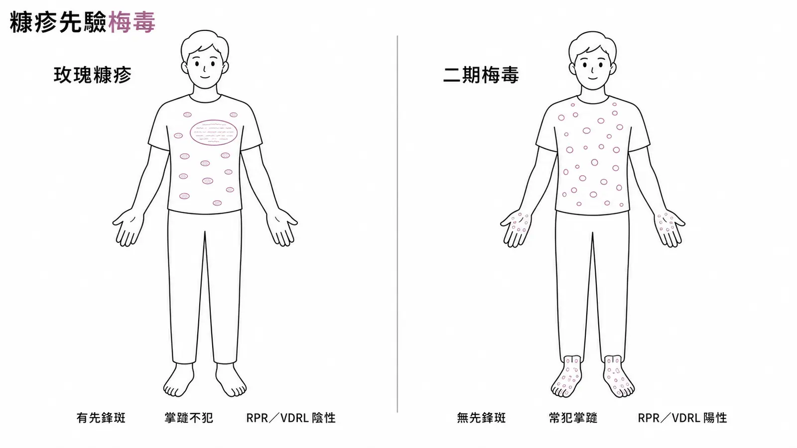 玫瑰糠疹與二期梅毒的鑑別對照:玫瑰糠疹有先鋒斑、通常不犯手掌腳掌、RPR/VDRL 陰性;二期梅毒無先鋒斑、常犯掌蹠、RPR/VDRL 陽性,是必須排除的鑑別